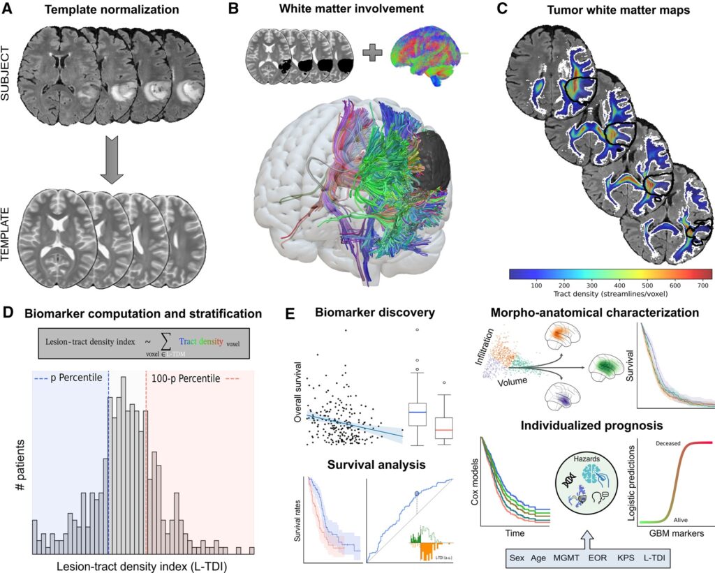 The lesion-tract density index (L -TDI): a survival marker in human GBM. (A) For every subject, the data were normalized to a common template. The T2-weighted image was chosen as the reference modality, and the GBM was inversely masked to discard distorted tissue during the optimization. (B) The normalized tumor mask is used in combination with the whole brain normative tractogram to extract the set of streamlines that intersect the tumor in the same template space as in (A). (C) The lesion-tract density map (L -TDM) provides a unique white matter density map describing the tracts in (B) that interact with the GBM. (D) From the L -TDM, we can define the L -TDI marker by averaging the tract density within the L -TDM binary mask in (C). For a given cohort, the sample can be stratified according to a given percentile. (E) Once a stratification threshold has been set, we conduct thorough tests to assess the discovery of the biomarker. Additional survival analyses on multiple stratification thresholds help determine whether the potential biomarker holds prognostic value. The L -TDI can also be used to characterize both morphological and anatomical landscapes in GBMs, which can be used to understand differences in the survival rates. Once a robust effect has been identified, the L -TDI can be incorporated into standard risk analysis and predictive frameworks to improve patient care.
